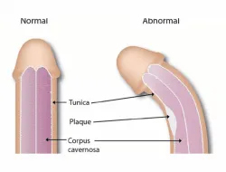 Apa Itu Penis Bengkok? Apakah Berbahaya dan Bisa Diluruskan?