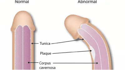 Apa Itu Penis Bengkok? Apakah Berbahaya dan Bisa Diluruskan?