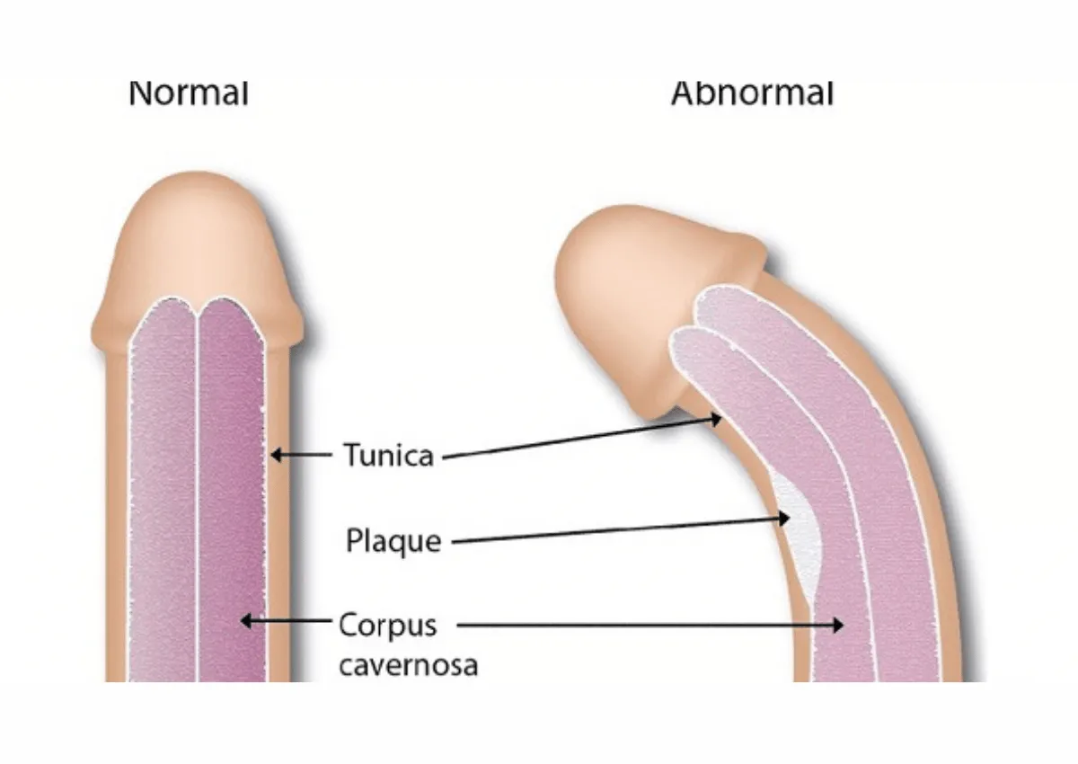 Penis Bengkok