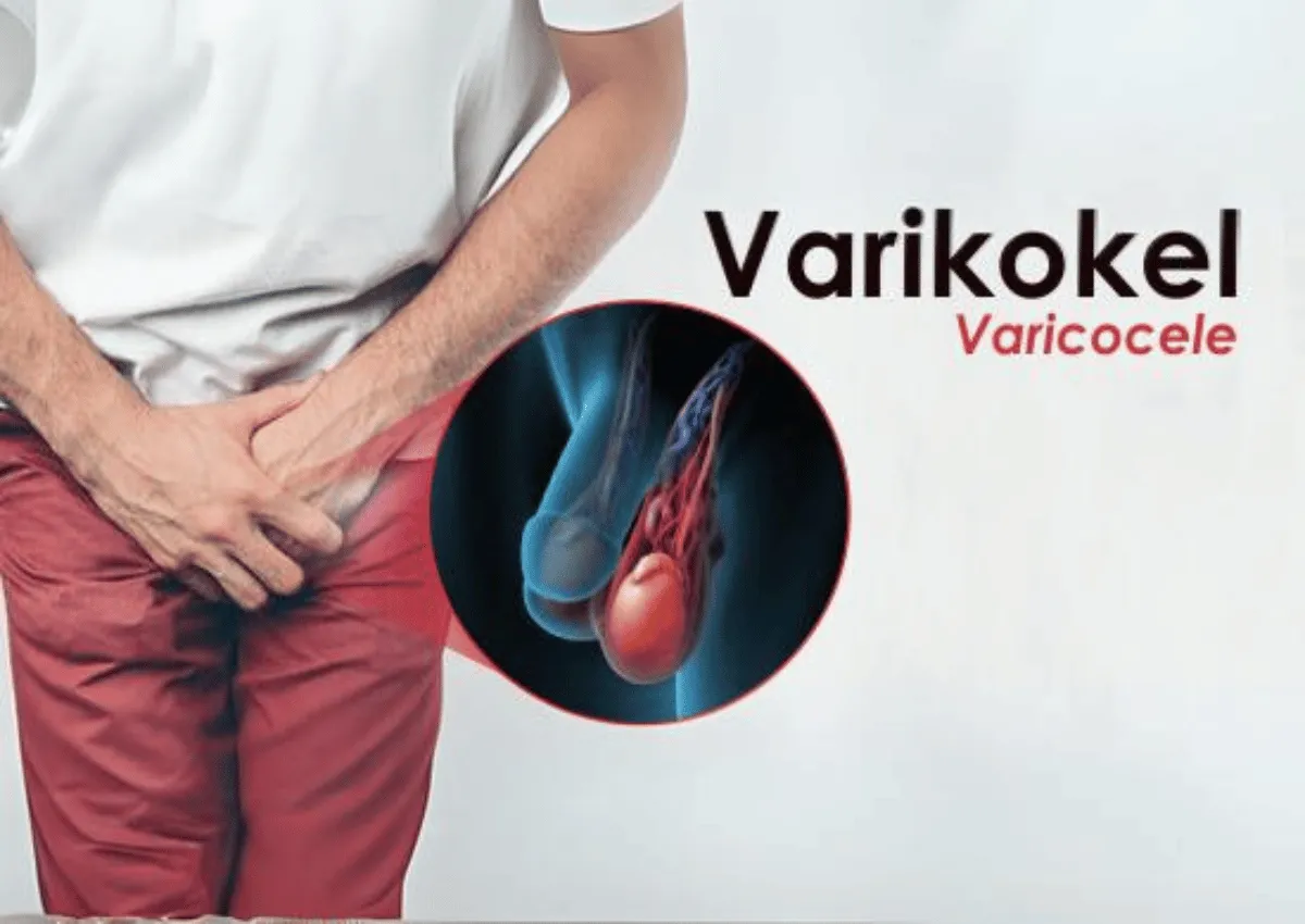 Varikokel