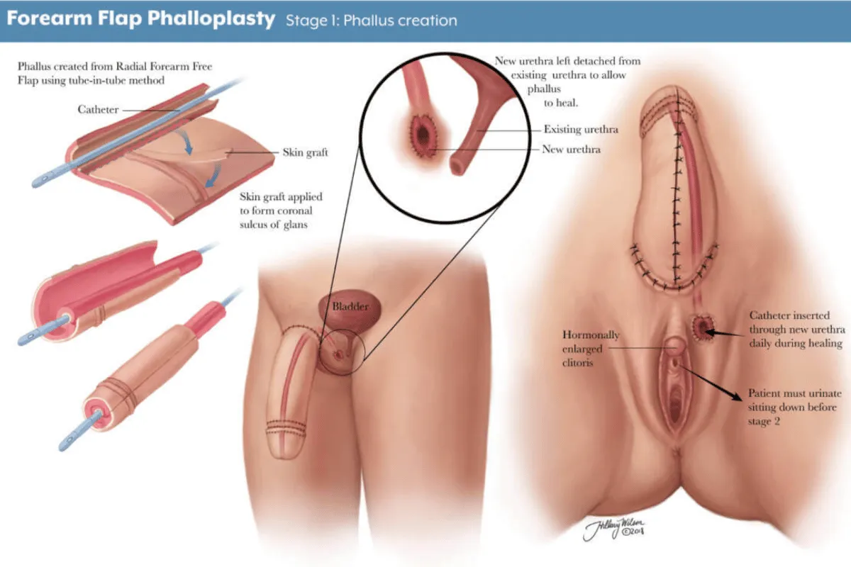 Phalloplasty