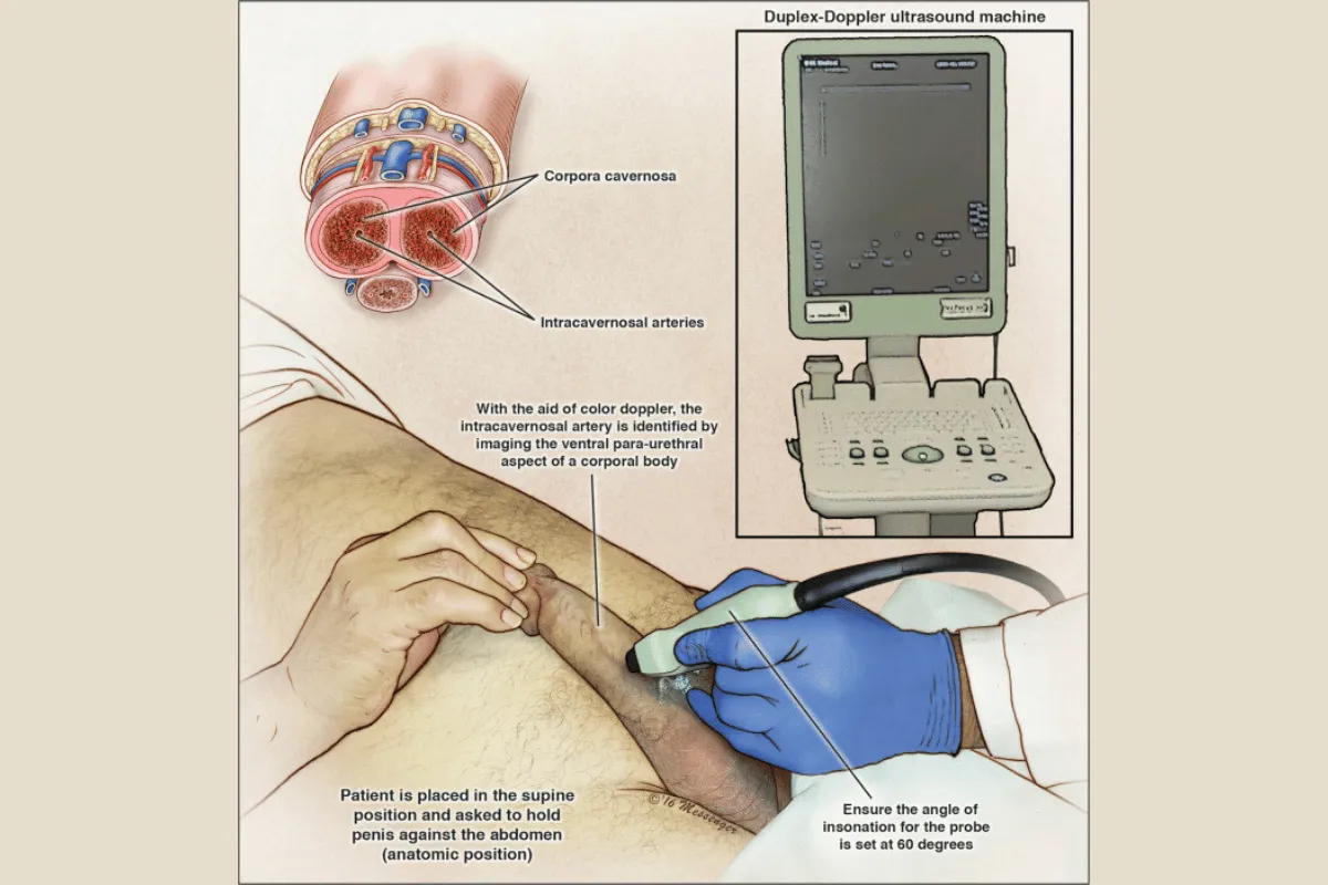 USG Doppler Dupleks Penis