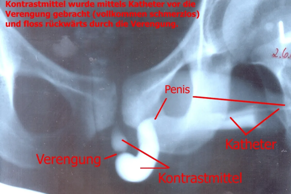 Diagnosis dan Tes untuk Penis Patah