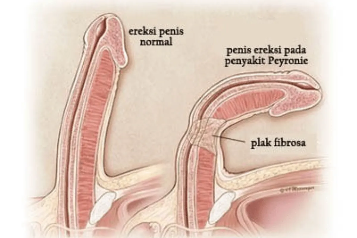 penyakit Peyronie