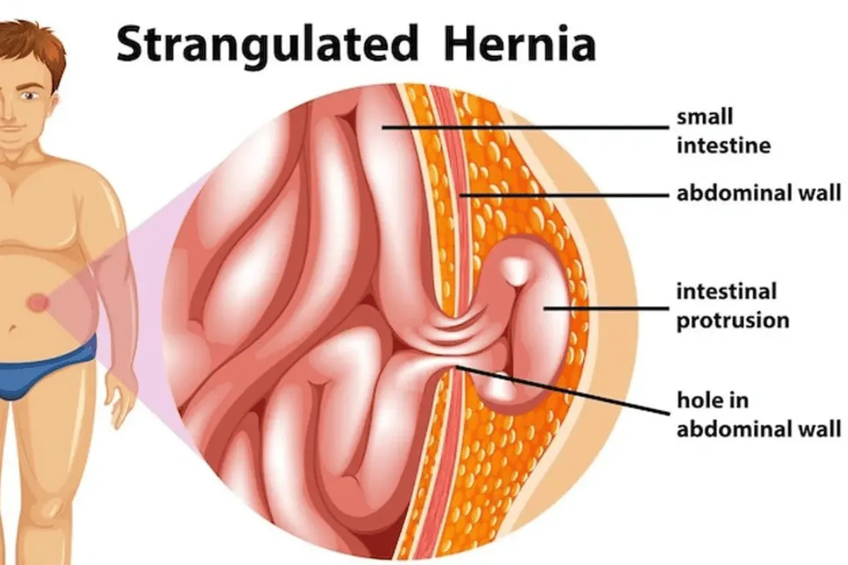 penyakit hernia.