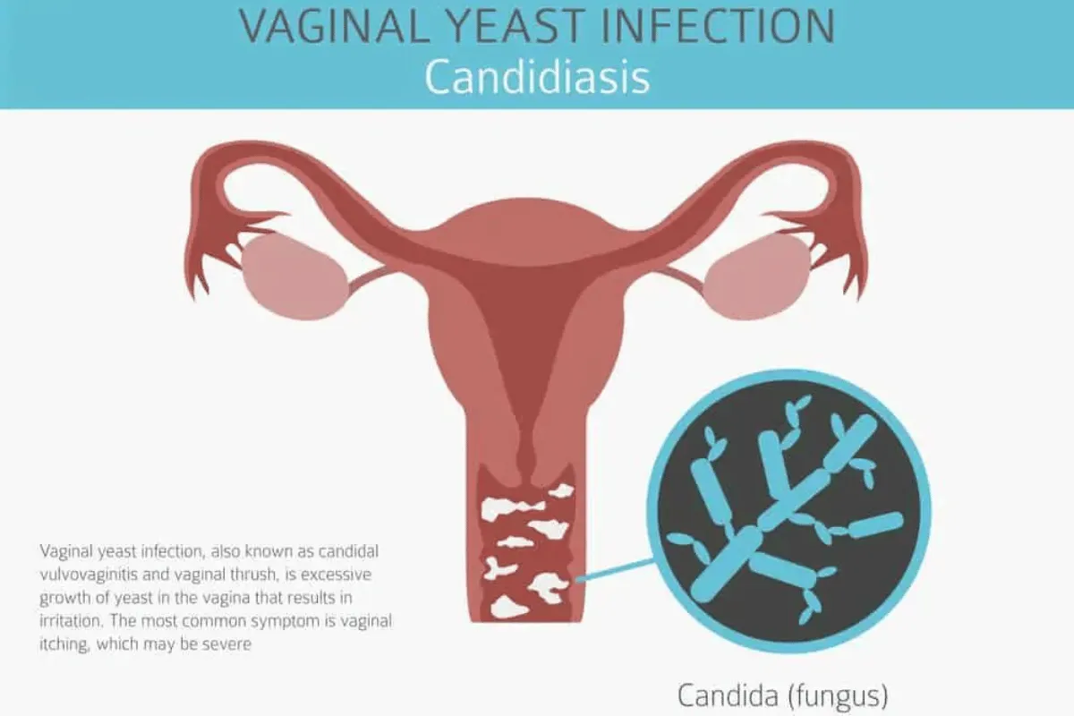 Apa Itu Infeksi Jamur Vagina